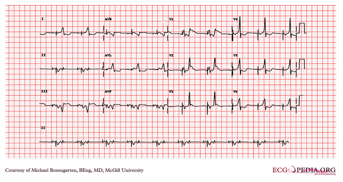 McGill Case 103 - ECGpedia