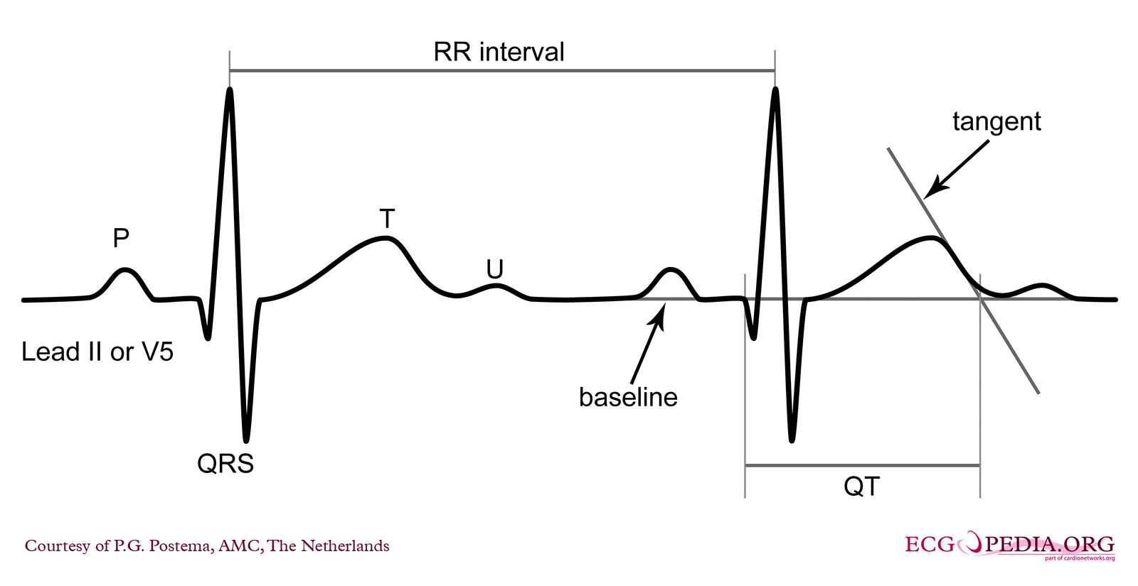 File:E000570.jpg - ECGpedia