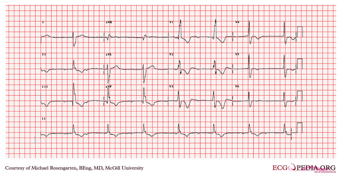 McGill Case 379 - ECGpedia