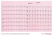 De Voogt ECG Archive - Supraventricular Rhythms - Atrial flutter - ECGpedia