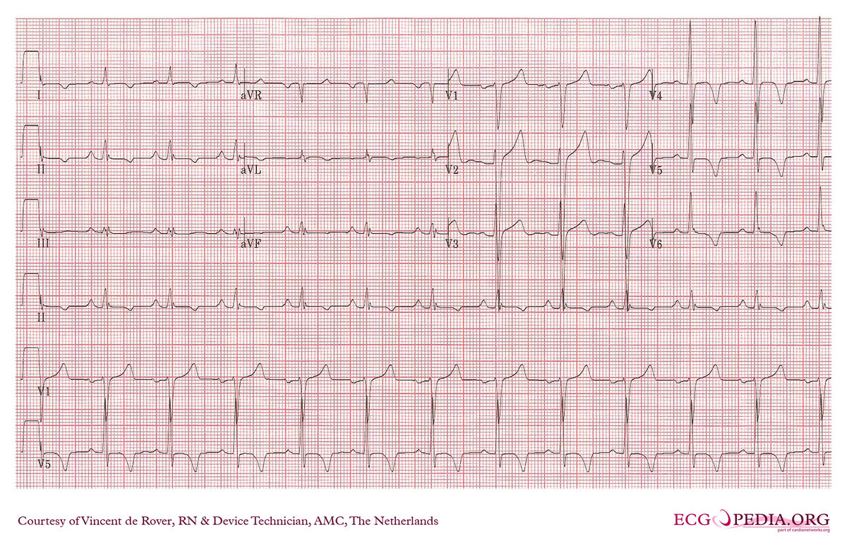 AMC Case 158 - ECGpedia