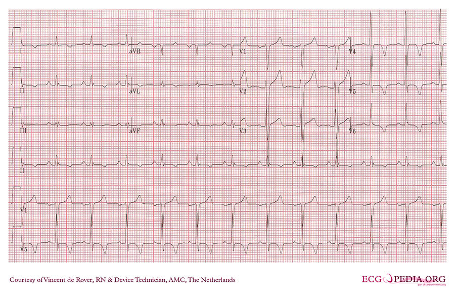 AMC Case 158 - ECGpedia