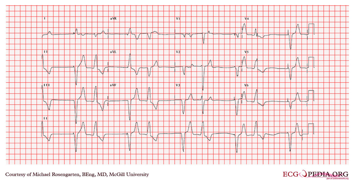 McGill Case 367 - ECGpedia