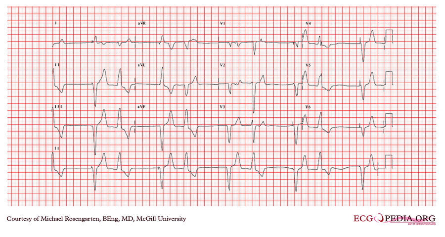 McGill Case 367 - ECGpedia