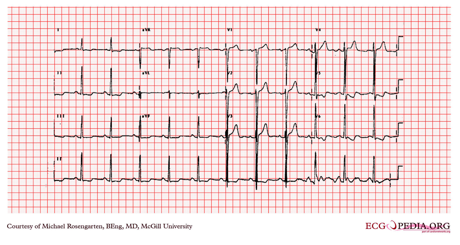 File:E242.jpg - ECGpedia