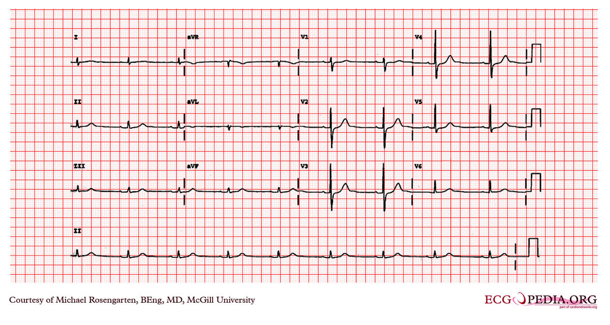 McGill Case 247 - ECGpedia