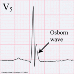 Osborn wave. 81-year-old black male with BP 80/62 and temperature 89.5 degrees F (31.94 C).