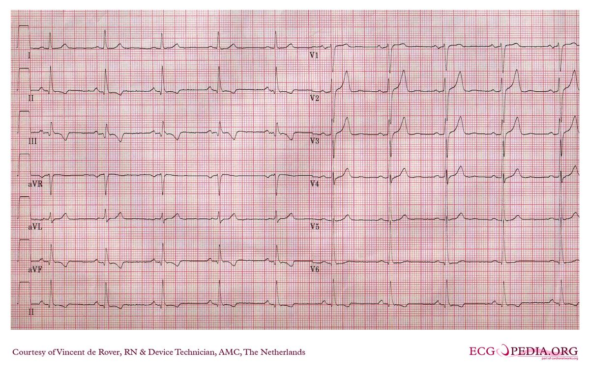 AMC Case 14 - ECGpedia