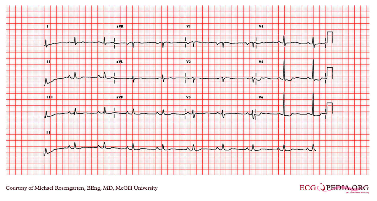 McGill Case 52 - ECGpedia