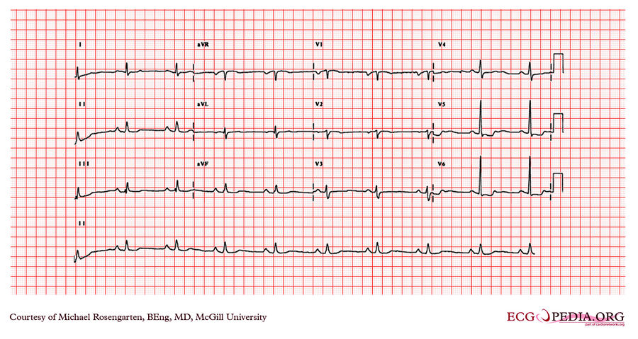 McGill Case 52 - ECGpedia