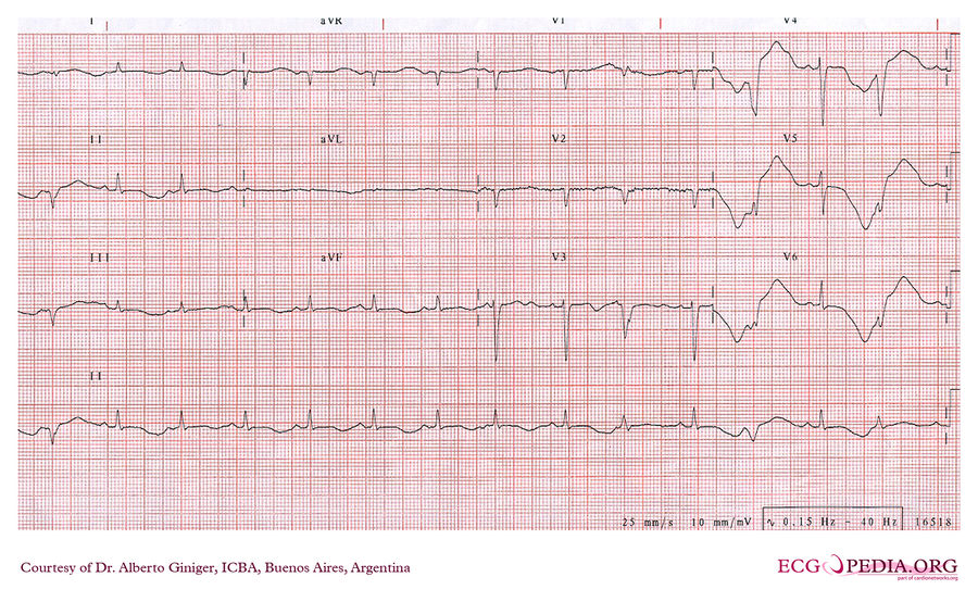 ICBA26 - ECGpedia