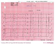 De Voogt ECG Archive - Electrolyte Disorders - ECGpedia