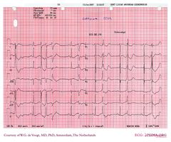 De Voogt ECG Archive - Electrolyte Disorders - ECGpedia