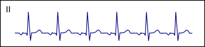 Supraventricular rhythms ecgpedia