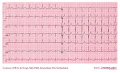 De Voogt ECG Archive - Supraventricular Rhythms - Atrial rhythm - ECGpedia