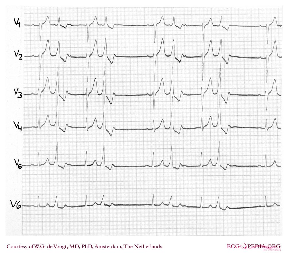 File:DVA0746.jpg - ECGpedia