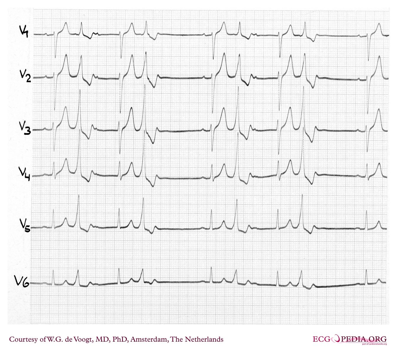 File:DVA0746.jpg - ECGpedia