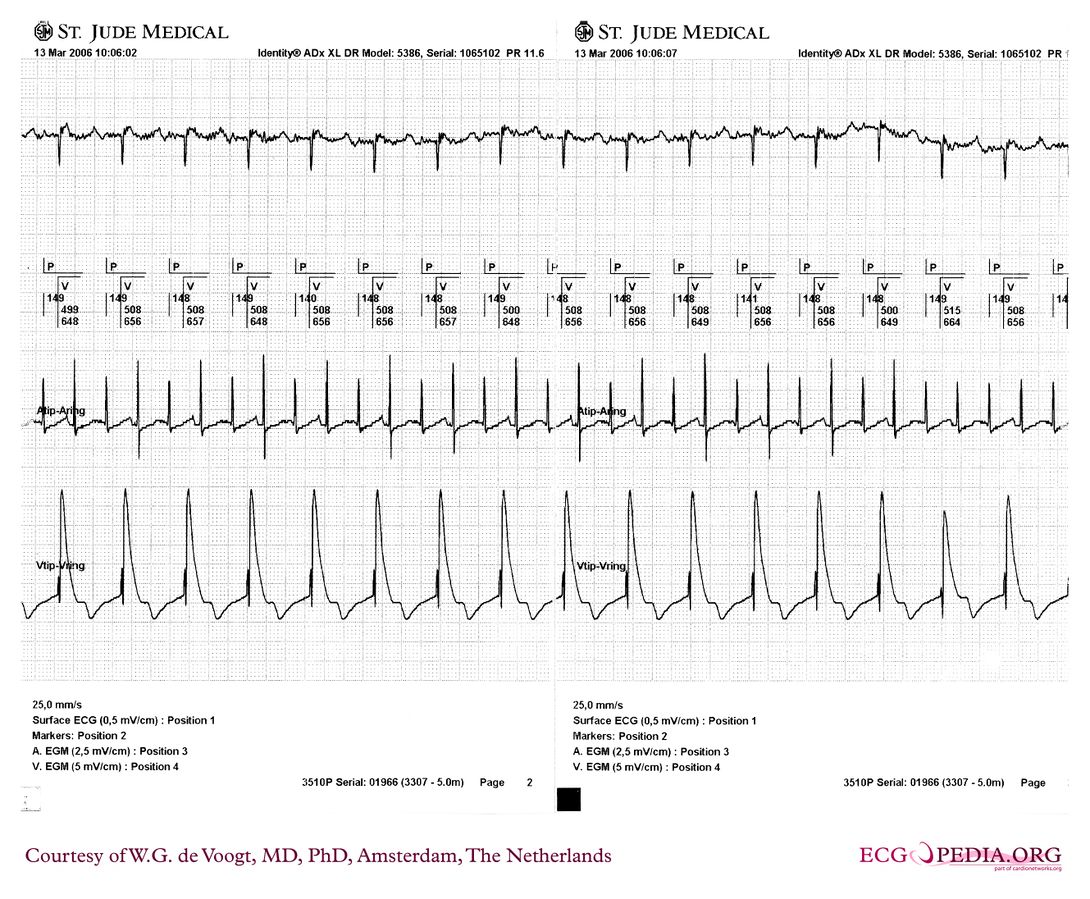 File:DVA1060.jpg - ECGpedia