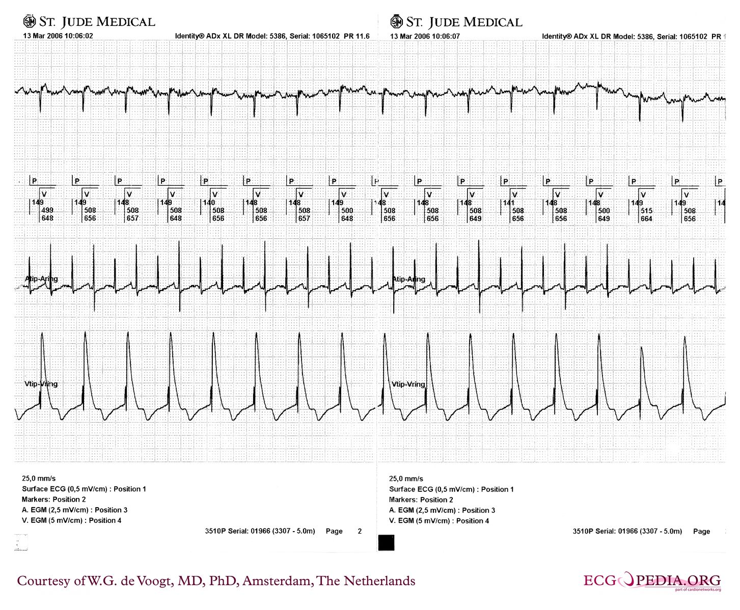 File:DVA1060.jpg - ECGpedia