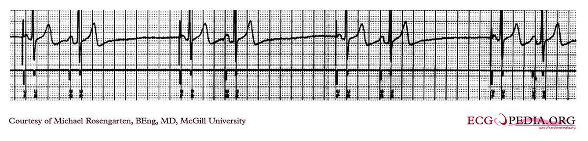 McGill Case 141 - ECGpedia