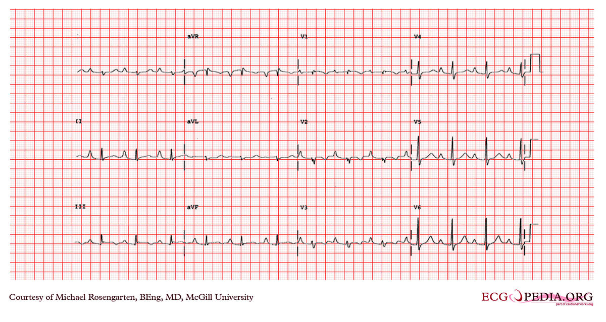 McGill Case 321 - ECGpedia