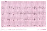 De Voogt ECG Archive - Supraventricular Rhythms - SSS - ECGpedia