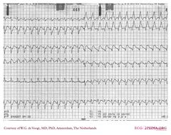 De Voogt ECG Archive - Myocardial Infarction - Anterior - ECGpedia