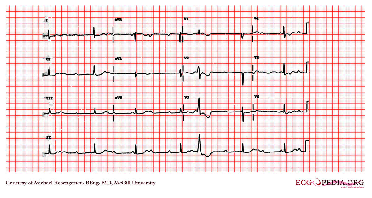 McGill Case 292 - ECGpedia