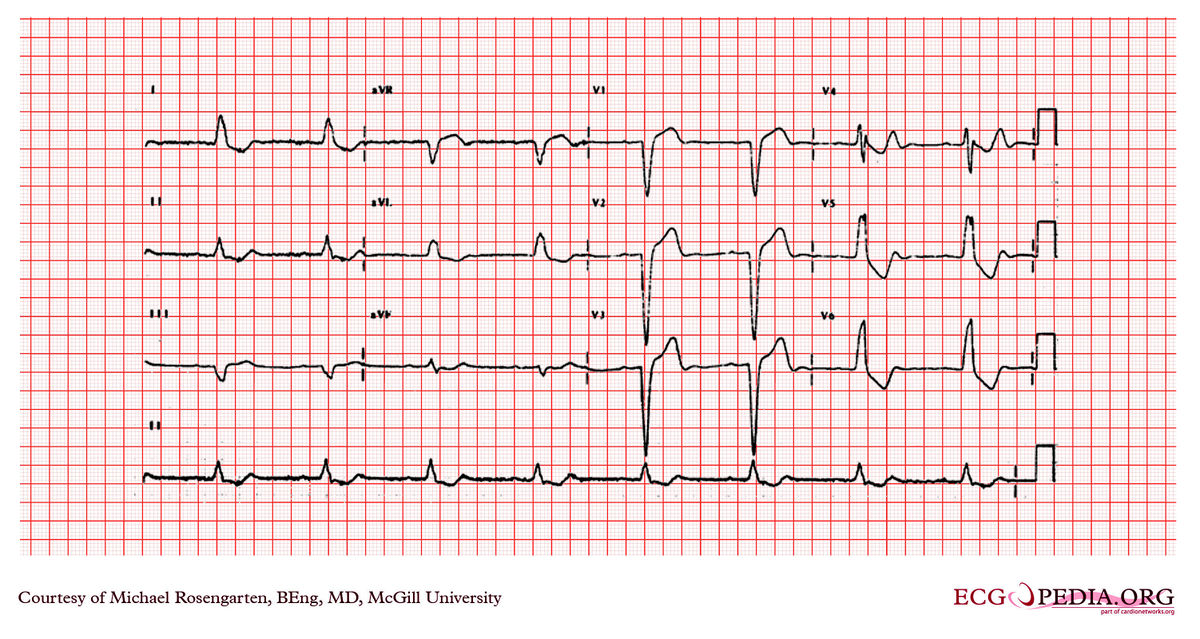 McGill Case 203 - ECGpedia