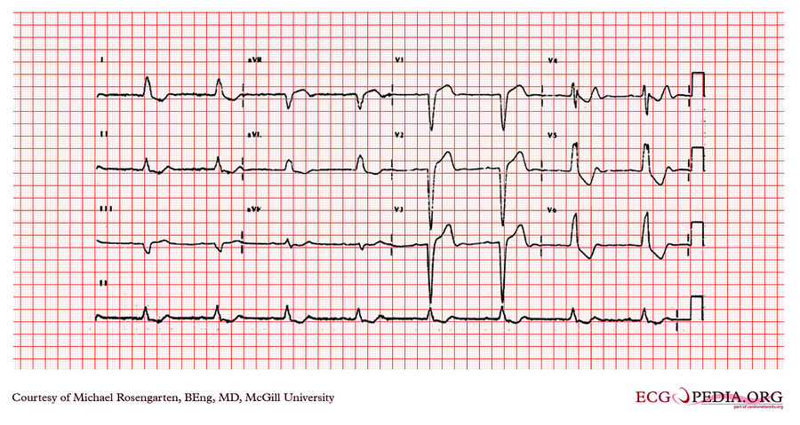 McGill Case 203 - ECGpedia