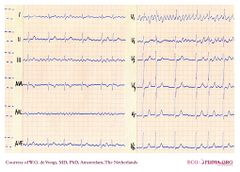 De Voogt ECG Archive - Supraventricular Rhythms - AF - ECGpedia