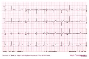 What Paced Rhythm Looks Like on Your Watch ECG