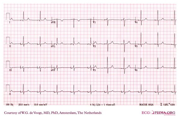 Pacemaker - ECGpedia