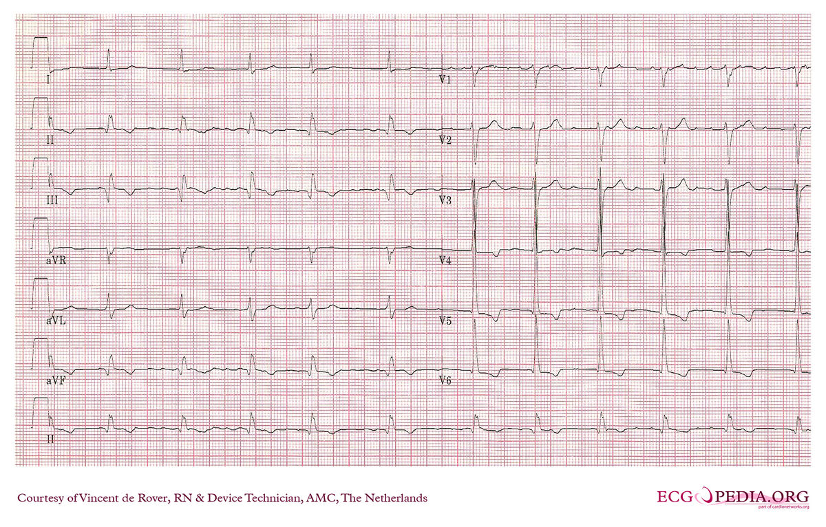 AMC Case 24 - ECGpedia