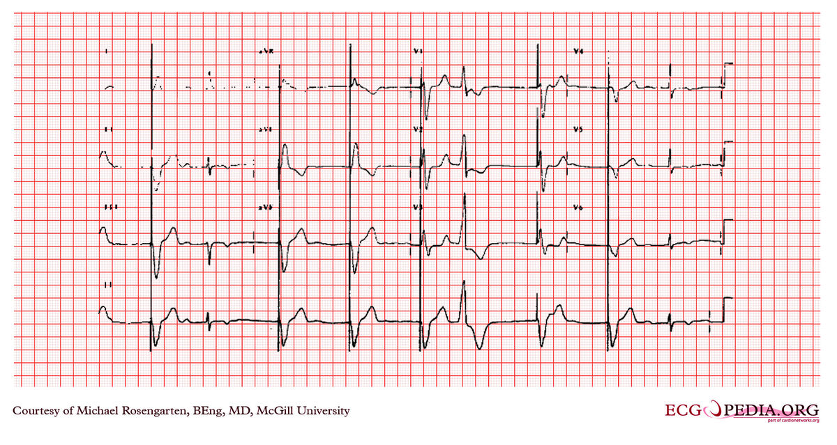 McGill Case 250 - ECGpedia