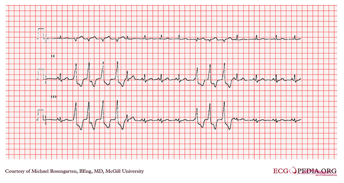 File:E000785.jpg - ECGpedia