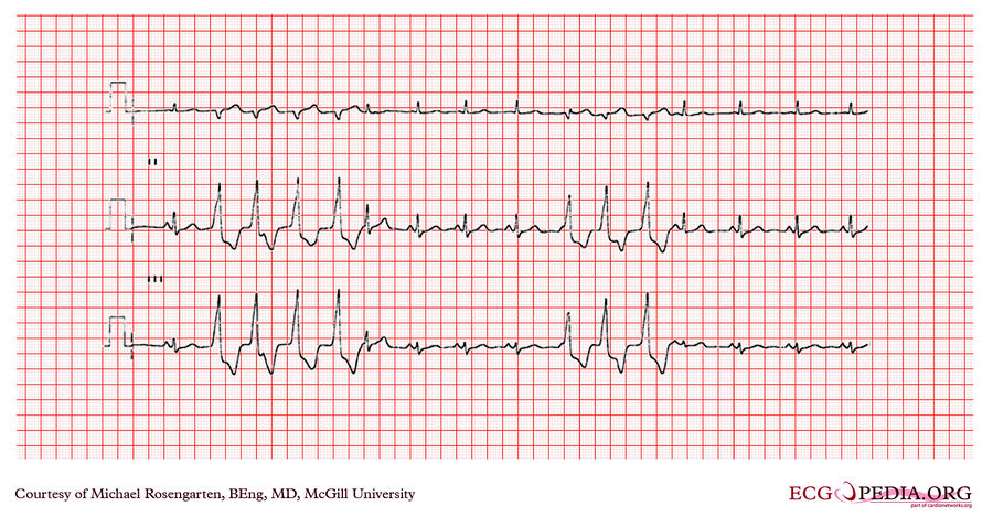 McGill Case 84 - ECGpedia