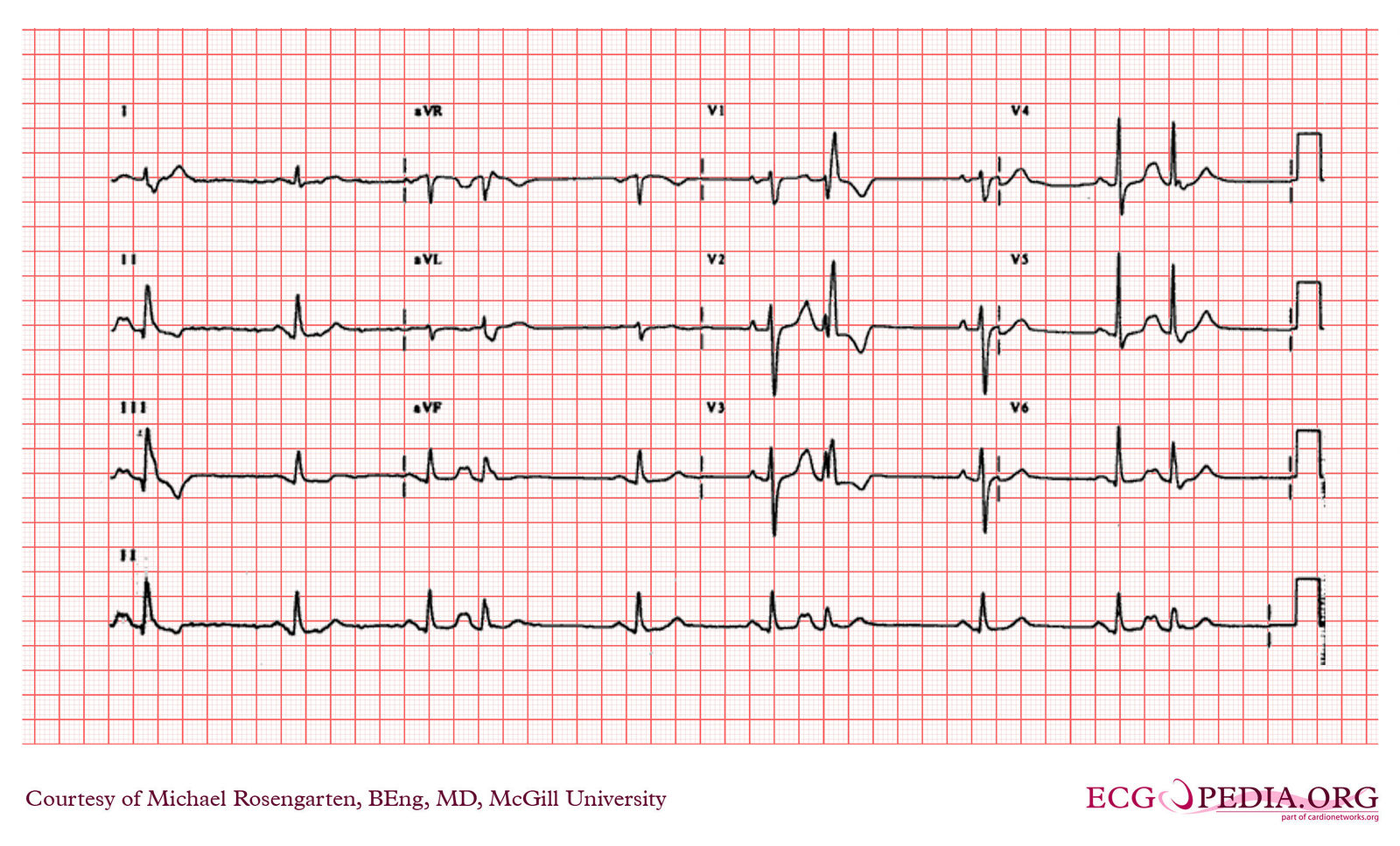 File:E000706.jpg - ECGpedia