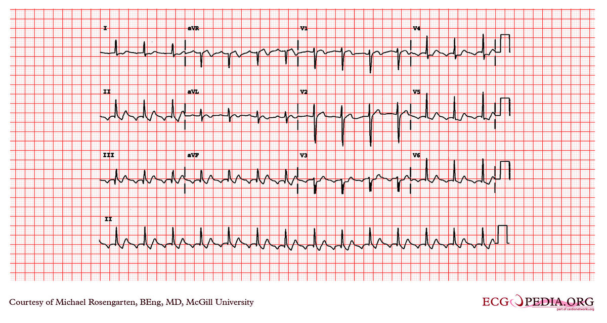 McGill Case 59 - ECGpedia