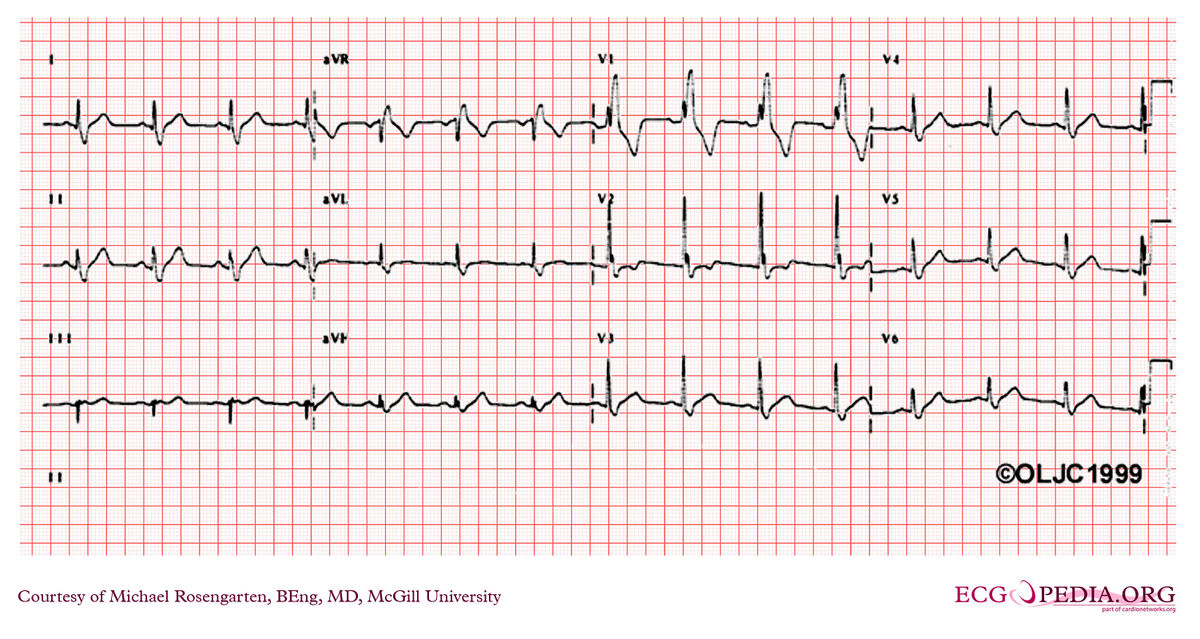 File:e000577.jpg - Ecgpedia