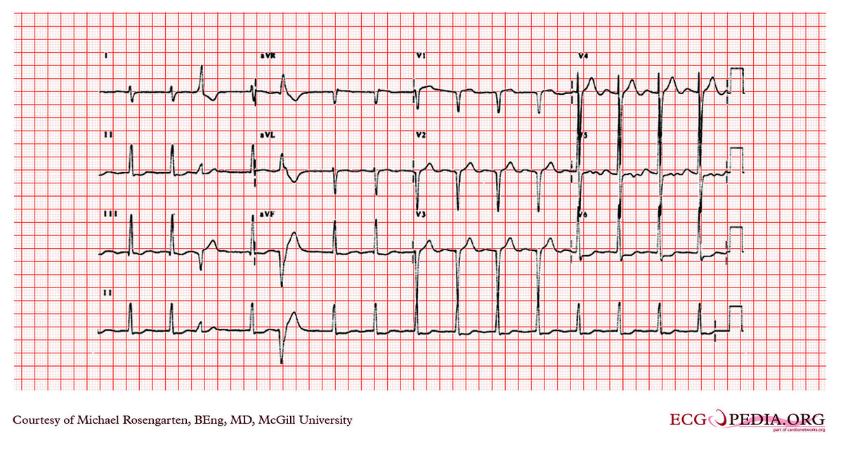 McGill Case 197 - ECGpedia