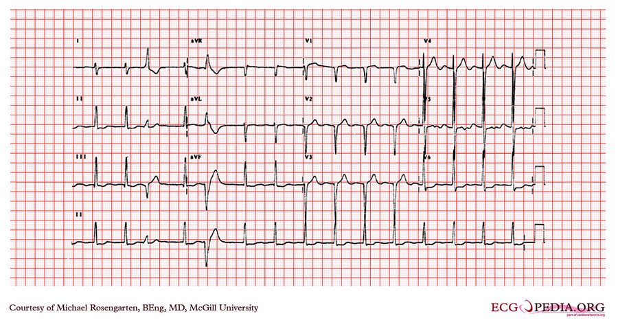 McGill Case 197 ECGpedia