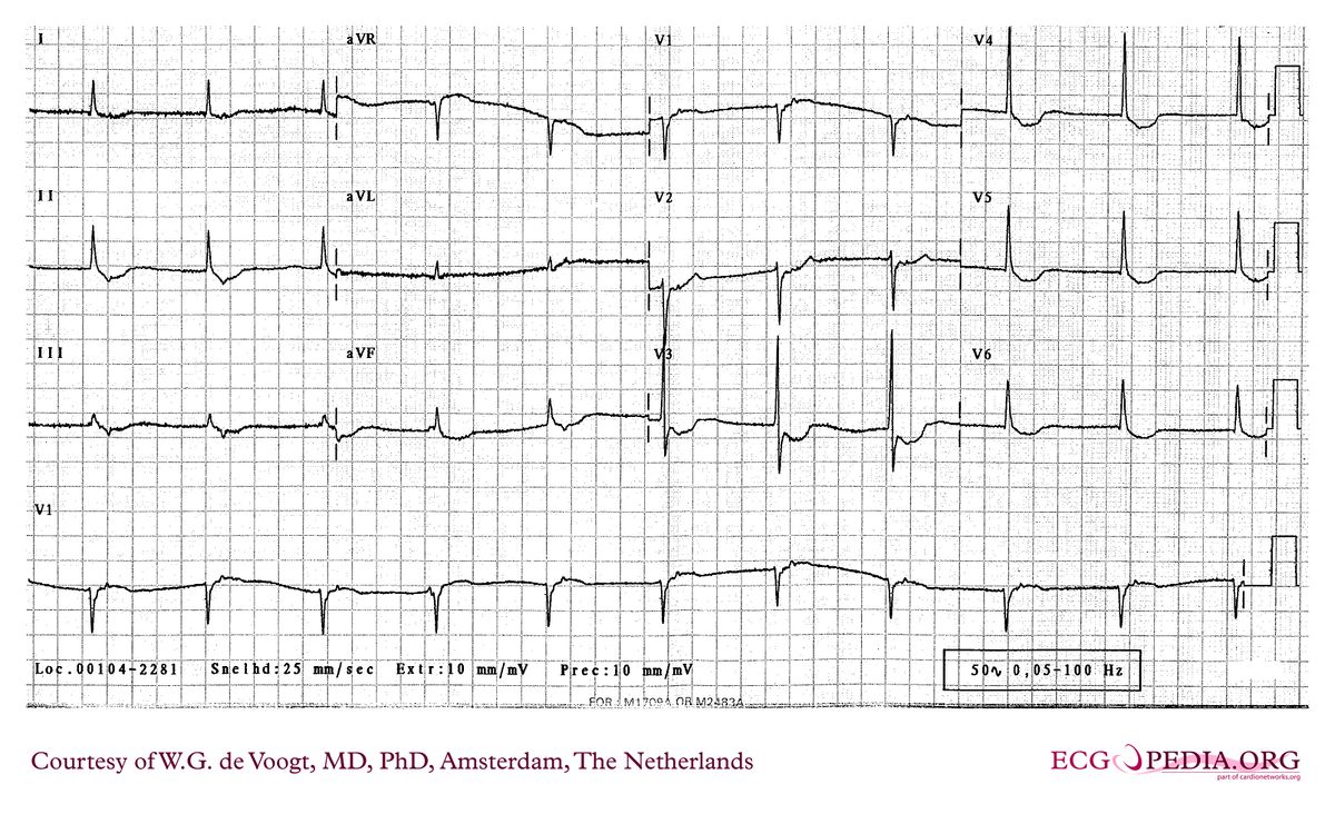 File:DVA0372.jpg - ECGpedia