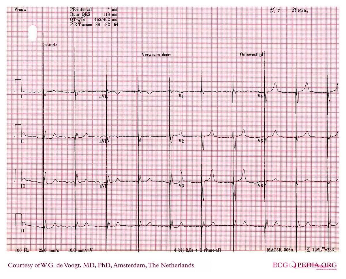 File:DVA0897.jpg - ECGpedia