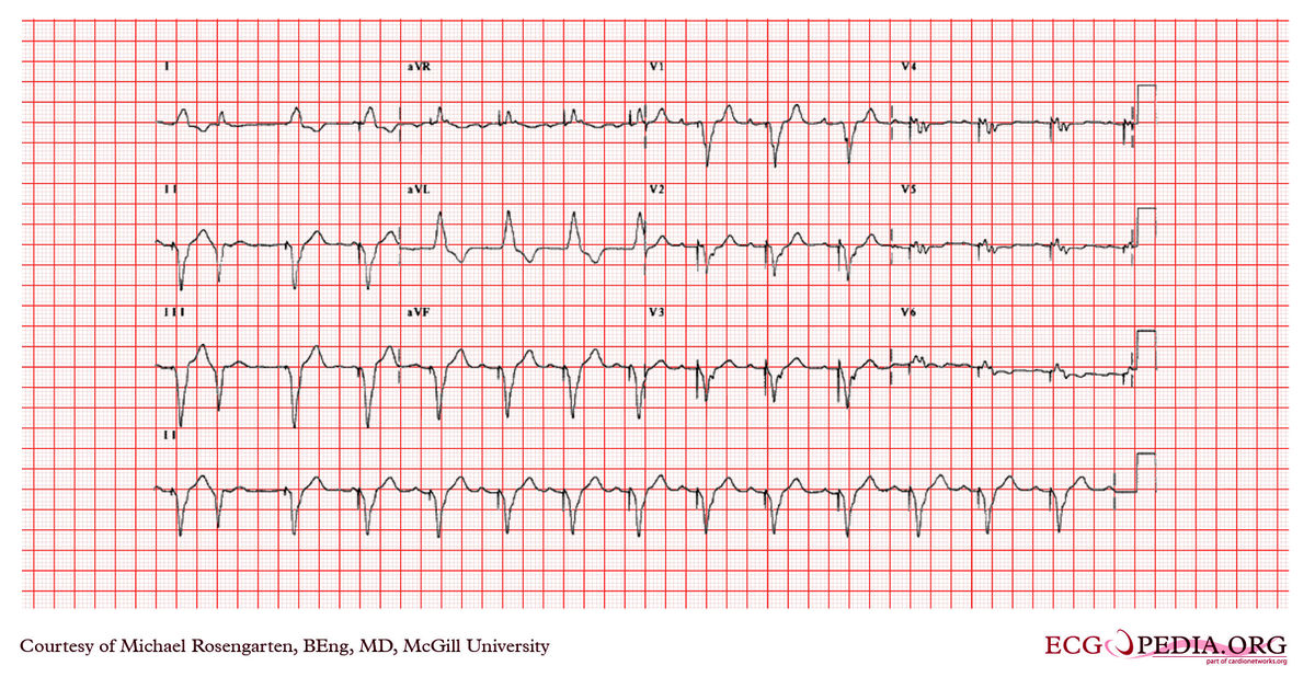 McGill Case 373 - ECGpedia