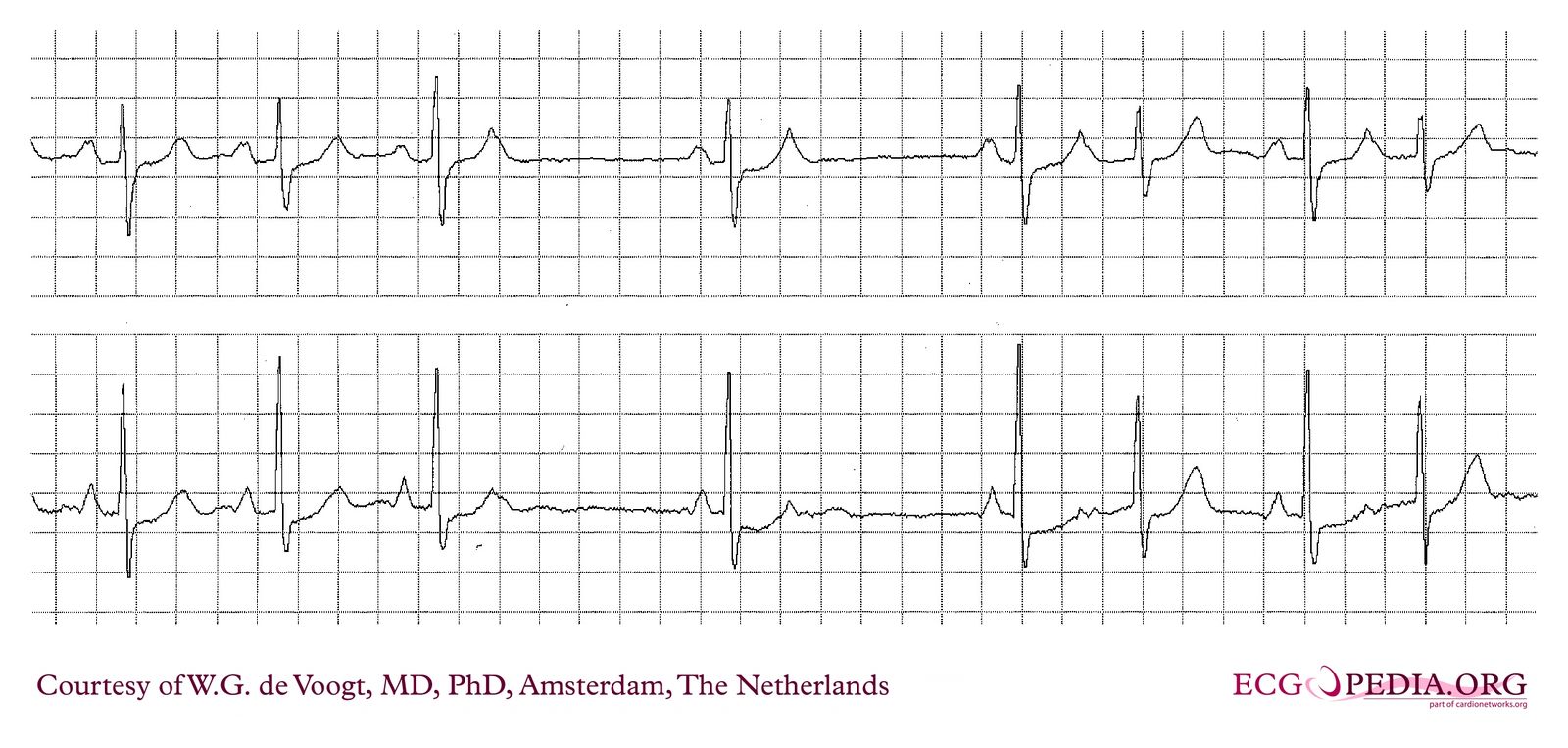 File:DVA0002.jpg - ECGpedia