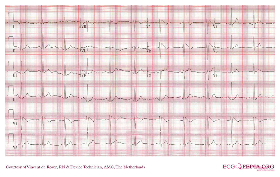 AMC Case 166 - ECGpedia