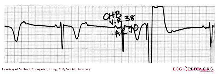 McGill Case 85 - ECGpedia