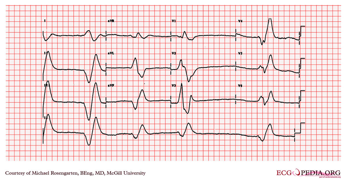 Mcgill Case 298 - Ecgpedia