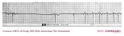 De Voogt ECG Archive - Supraventricular Rhythms - SSS - ECGpedia